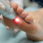 검버섯제거 레이저 비용