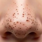 검버섯레이저 후 딱지